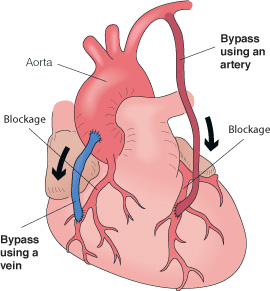 An artery bypass surgery for heart diseases