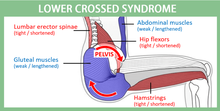 The sitting anatomy of Lower Crossed Syndrome