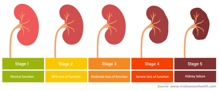 Stages of kidney disease