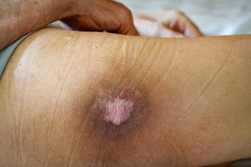 Pressure sore on the skin of an old man