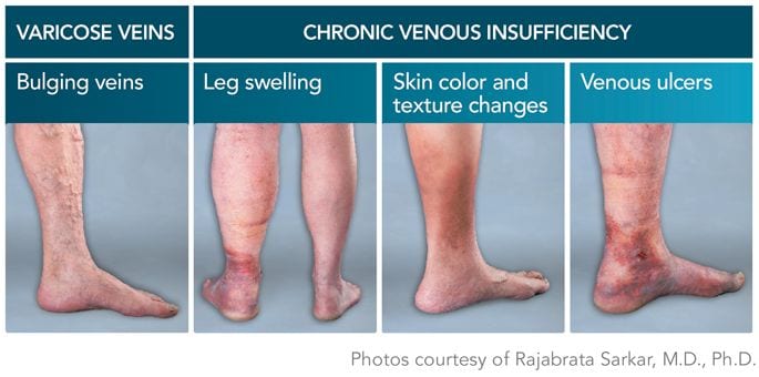 Chronic venous insufficiency