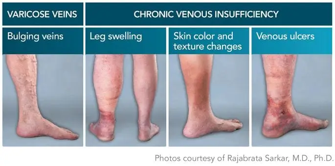 Chronic venous insufficiency