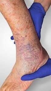 Venous ulcers in elderly