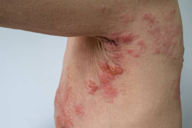 Shingles